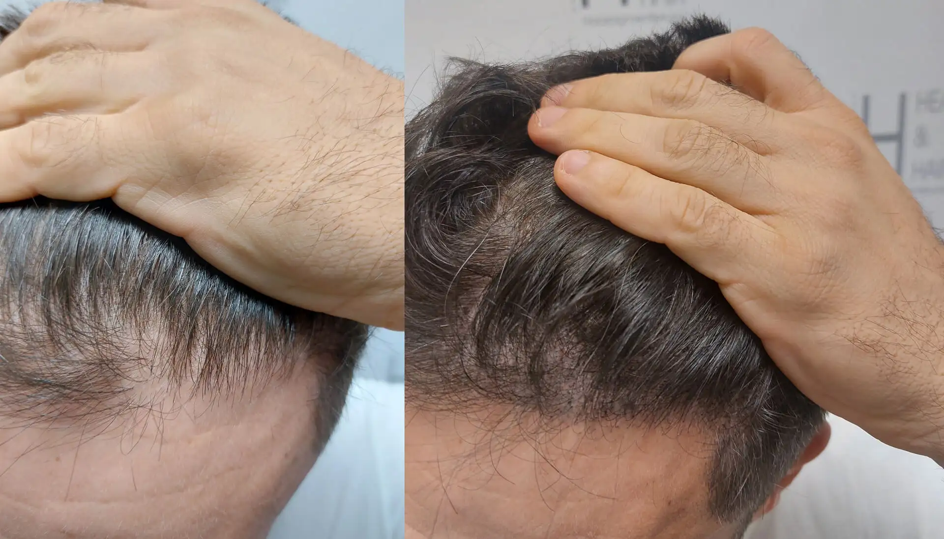 Haarverdichtung vorher und nach der Haarpigmentierung