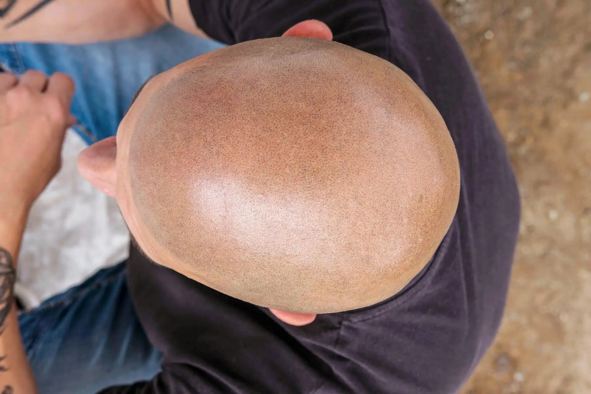 Stoppelhaar Look nach der Haarpigmentierung – Draufsicht