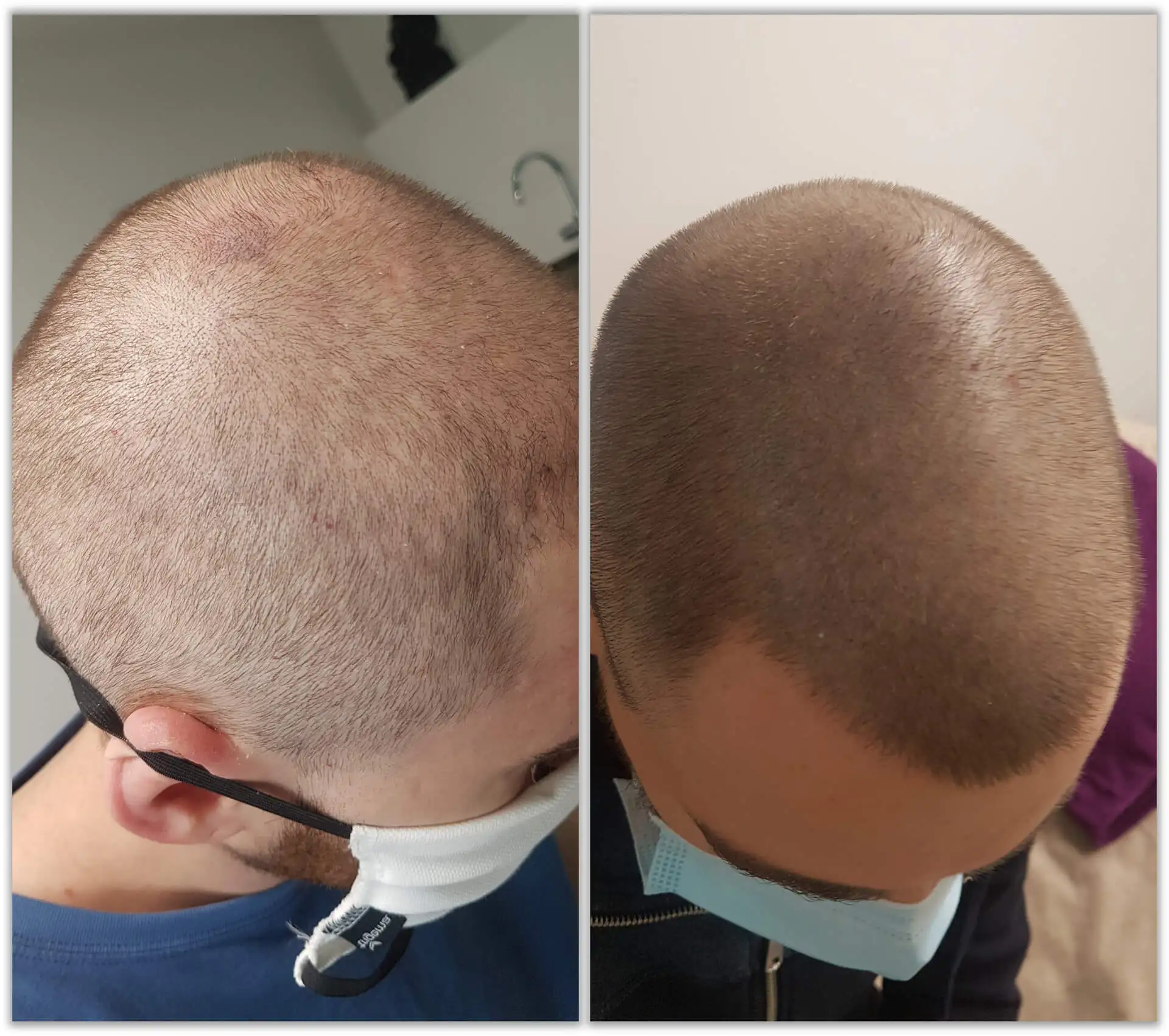 Lichte Haare vorher und nach der Haarpigmentierung – Haarverdichtung