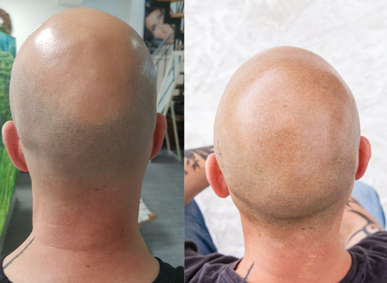 Stoppelhaar Look Hinterkopf vor und nach der Haarpigmentierung
